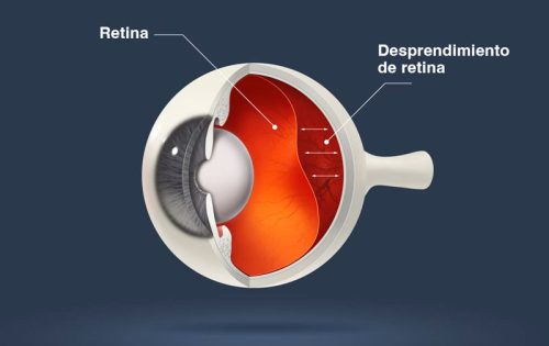 despredimeinto-retina-2